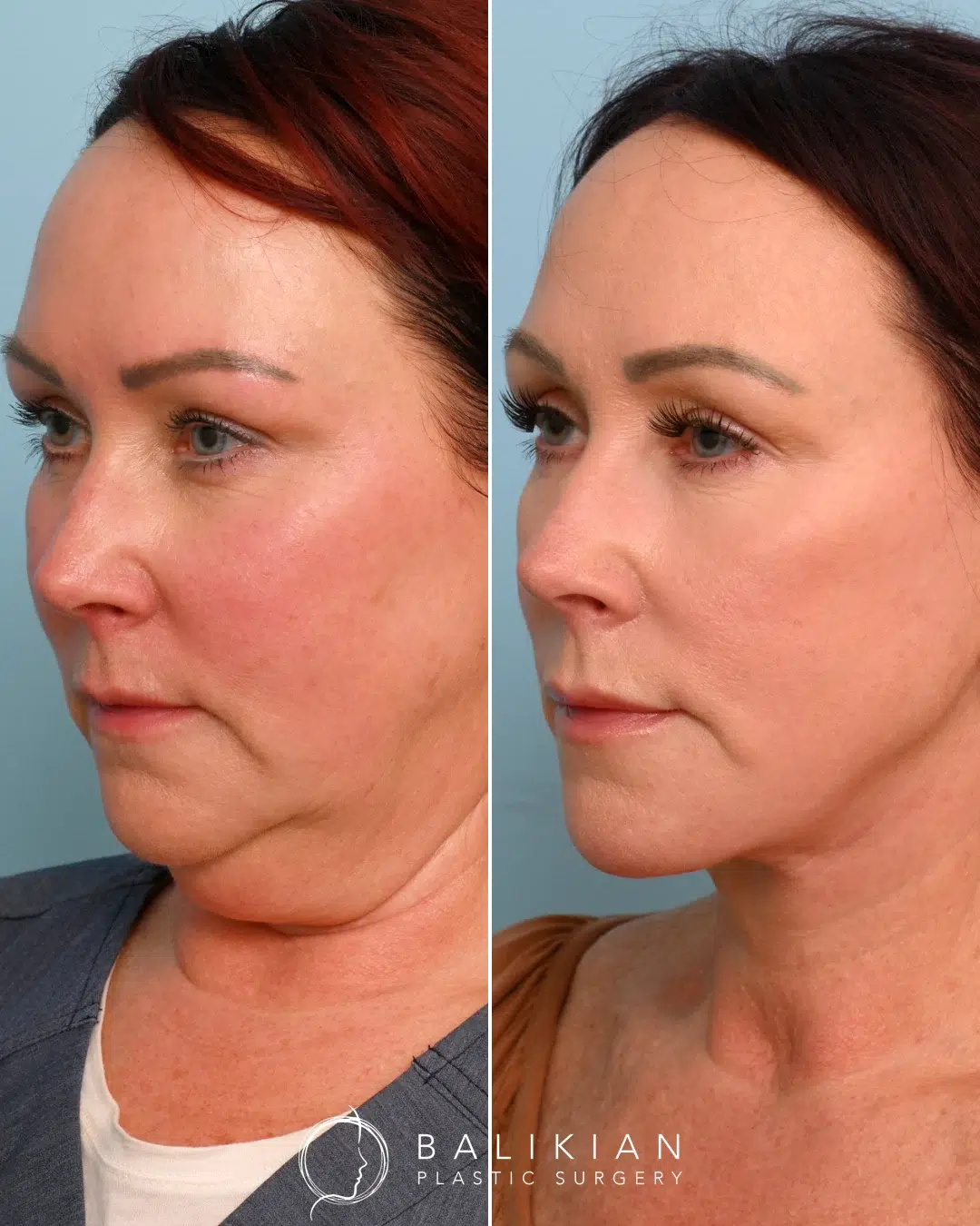 Oblique view comparing pre- and post-operative results with visible tightening of the lower face, neckline, and restored facial harmony