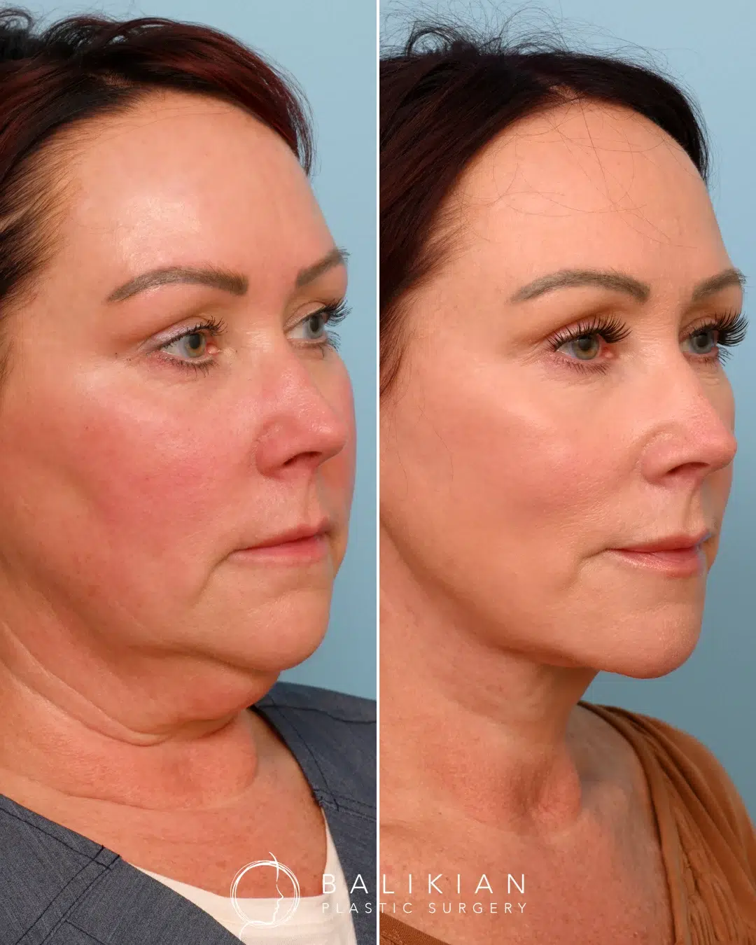 Three-quarter angle before and after images showcasing sculpted jawline, lifted cheeks, and smoother neck after an Artiste Lift deep plane facelift