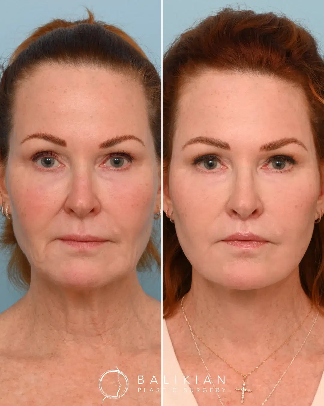 Before and after photos of a woman facing forward, showing full facial rejuvenation with improved jawline definition, lifted cheeks, and smoother skin