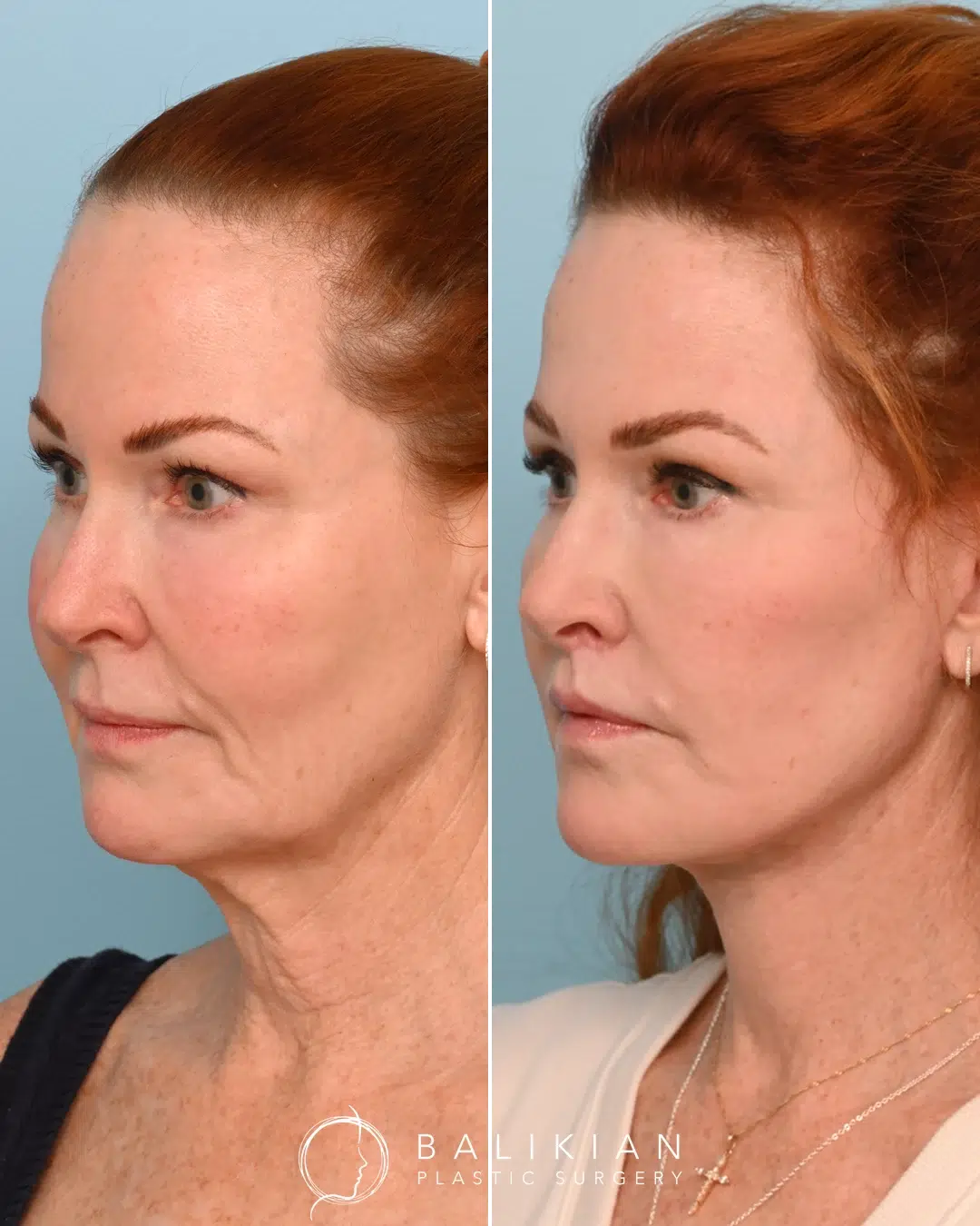 Before and after profile view of a woman, highlighting a tighter neckline, smoother jawline, and restored facial contours after facelift and neck lift