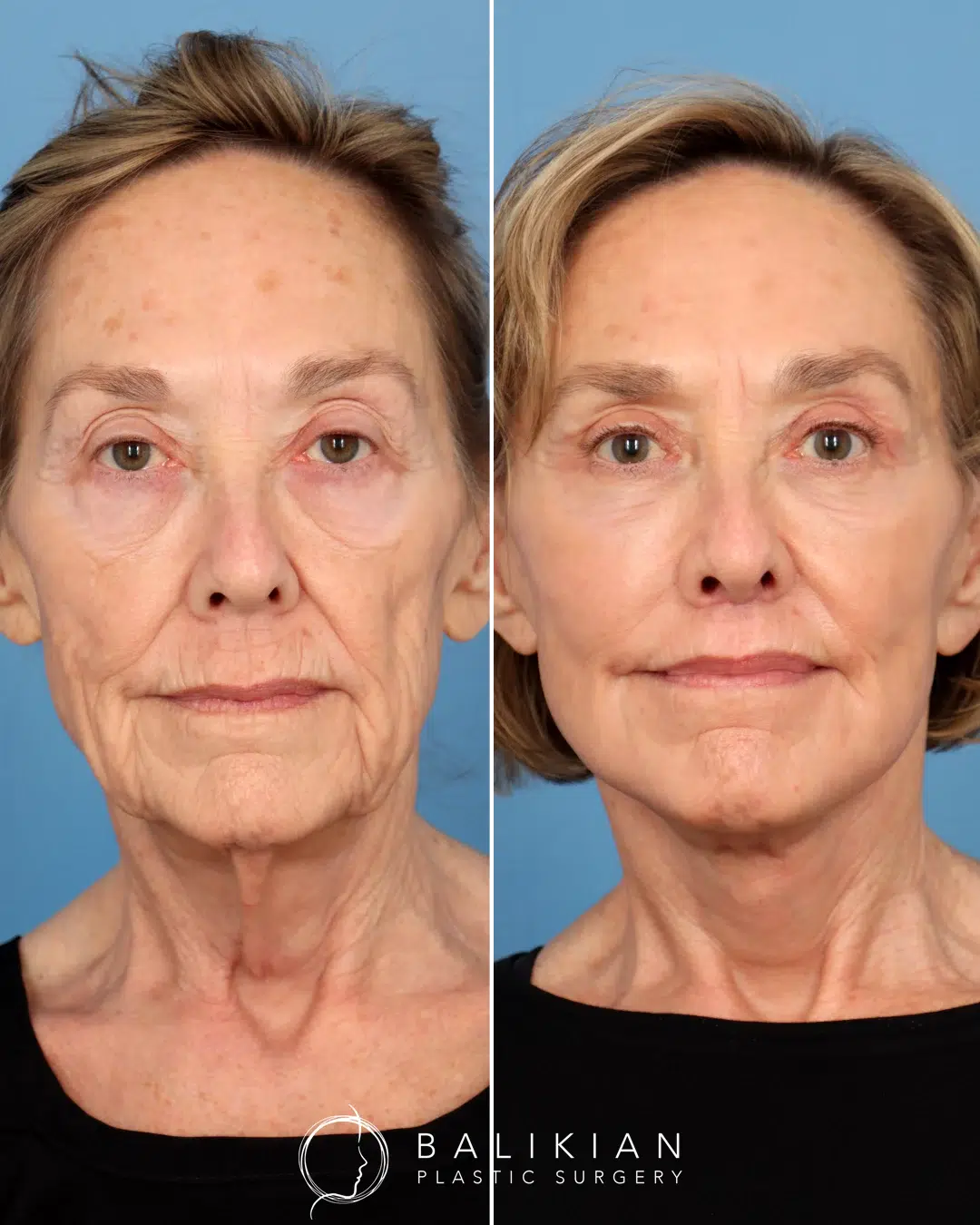 Frontal view of a female patient before and after deep plane facelift, showing lifted lower face, firmer skin, and softened nasolabial folds