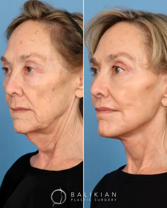 Angled view of the same patient, illustrating a more defined jawline, lifted cheeks, and natural skin tightening following a facelift