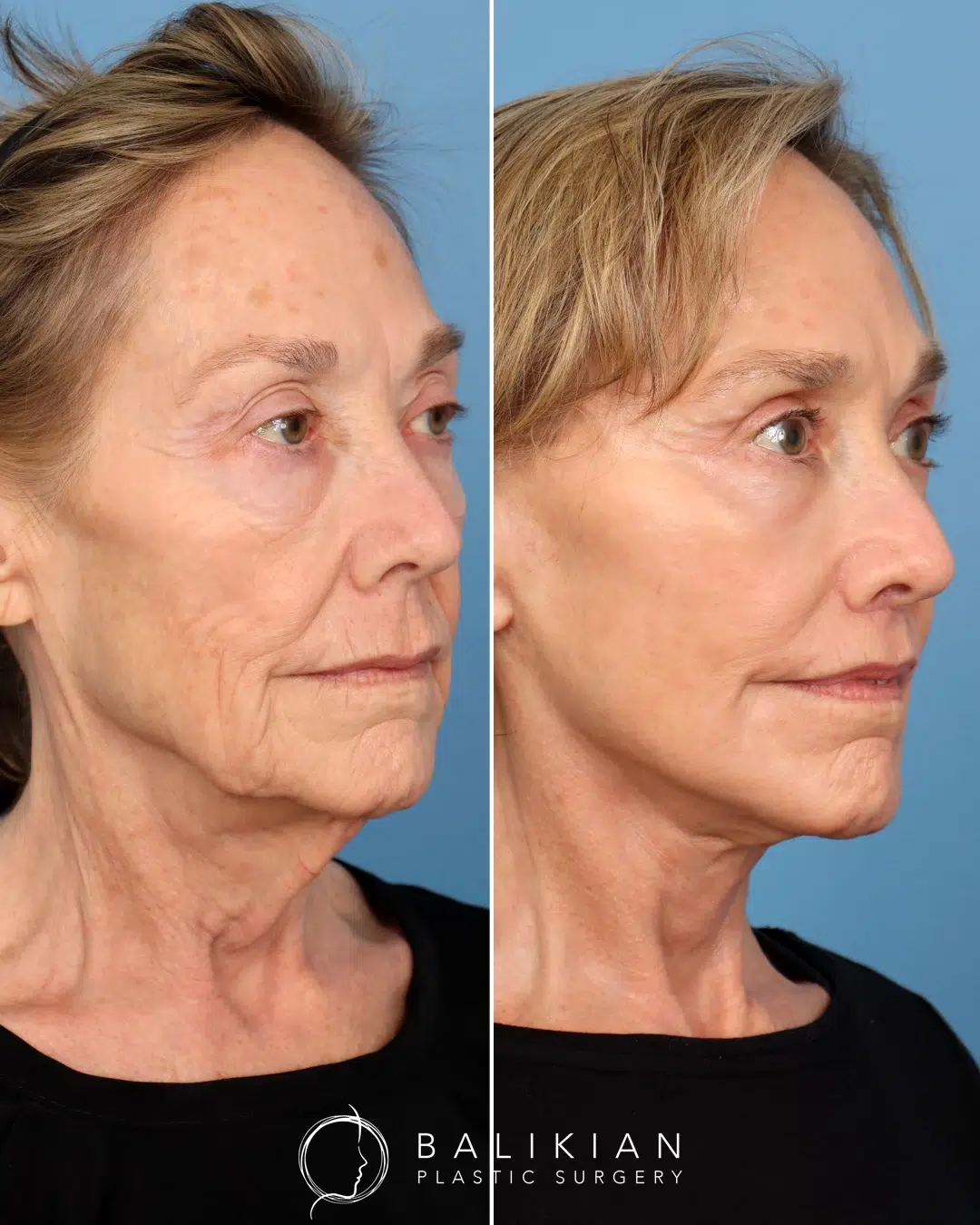 Side profile of the same patient, showing improvement in neck contour, reduced skin laxity, and a youthful jawline after surgery