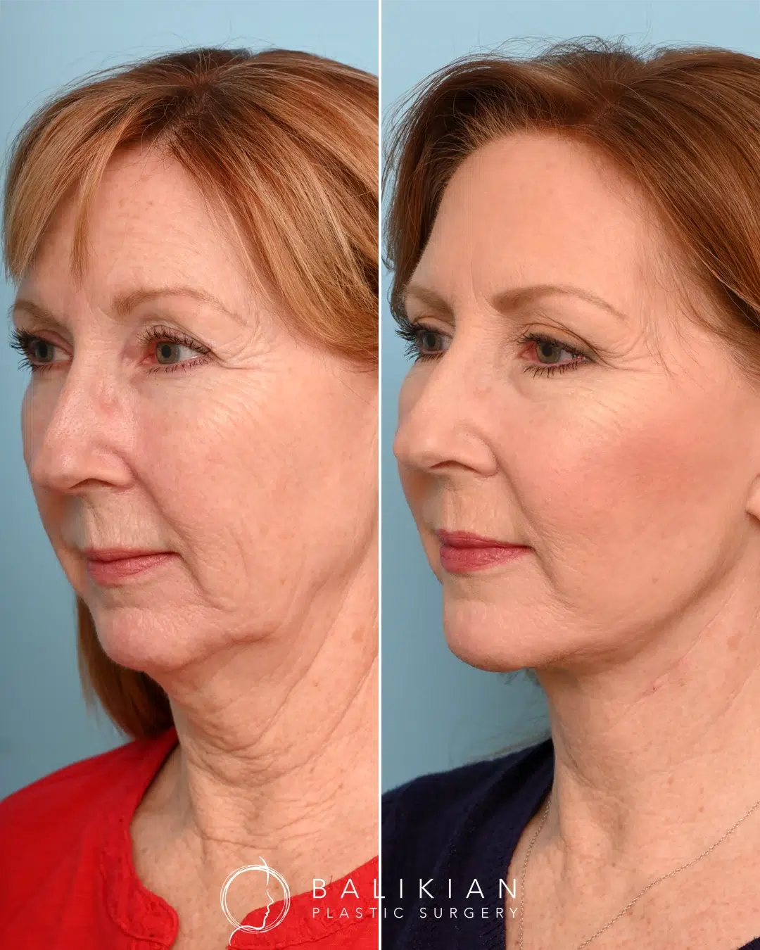 Side-by-side images showing visible improvement in facial sagging and neck laxity after a deep plane facelift and neck lift by Dr. Balikian