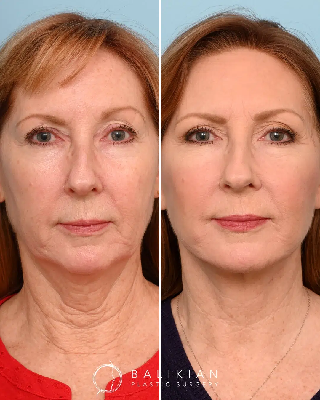 Frontal view showing smoother jawline, lifted cheeks, and tighter neck contour after comprehensive facial rejuvenation surgery