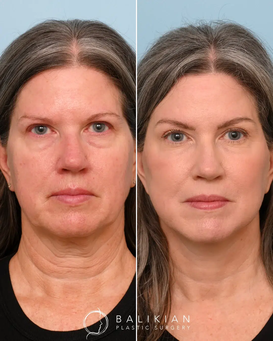 Frontal view of a female patient before and after an Artiste Lift, displaying a smoother neckline, lifted jowls, and refreshed facial appearance