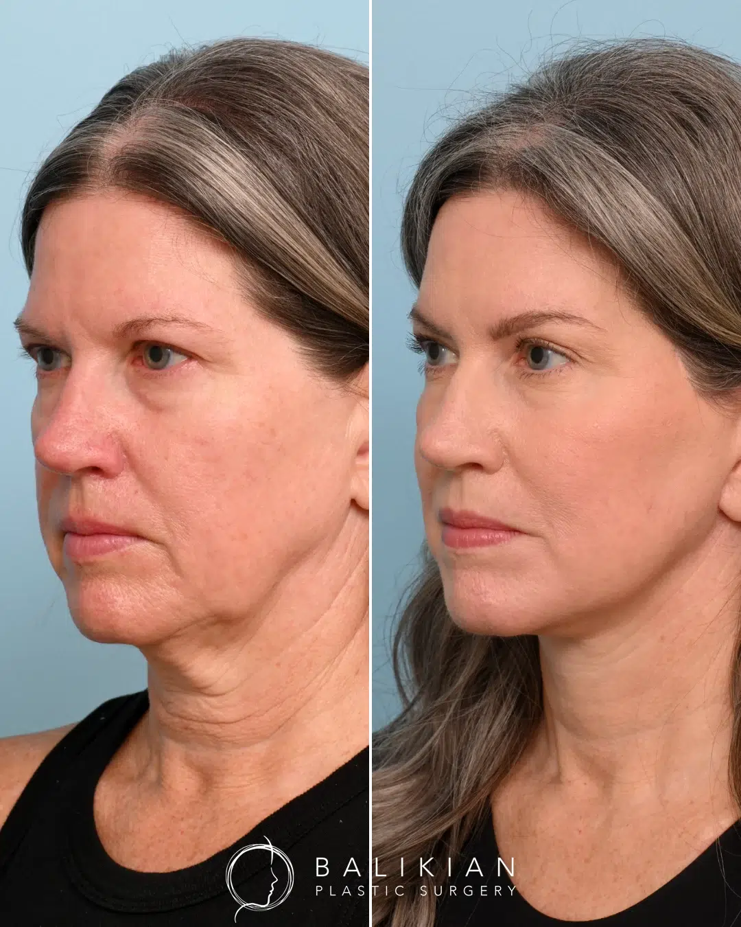 Angled comparison of the same patient, highlighting enhanced cheek volume, improved skin tone, and natural rejuvenation