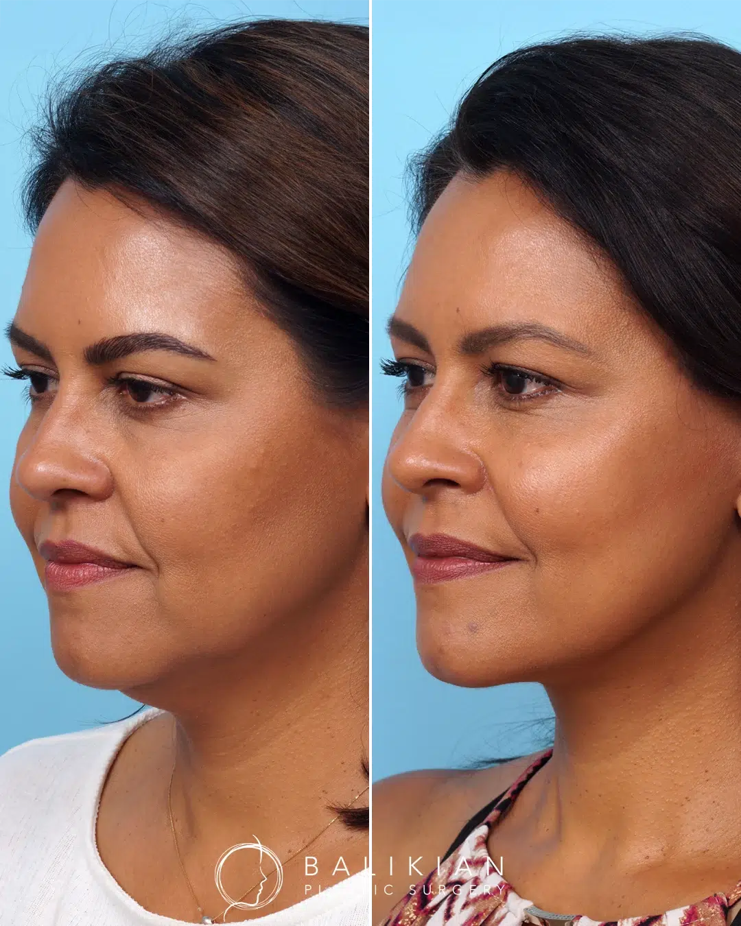 Oblique angle view revealing a sharper jawline, reduced fullness under the chin, and natural volume restoration to the midface