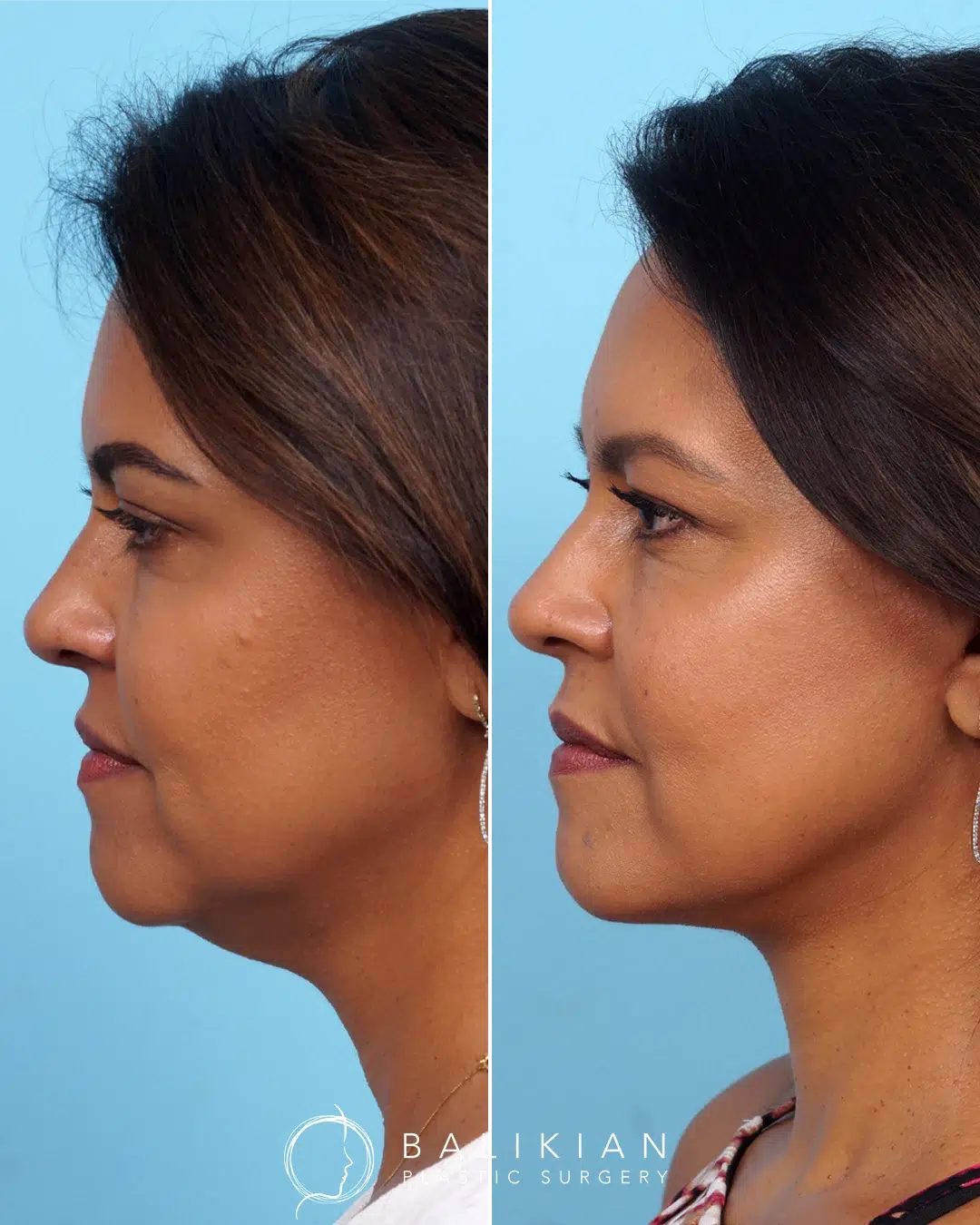 Side-by-side photos highlighting a refined lower face and enhanced cheek contour with natural-looking facial definition