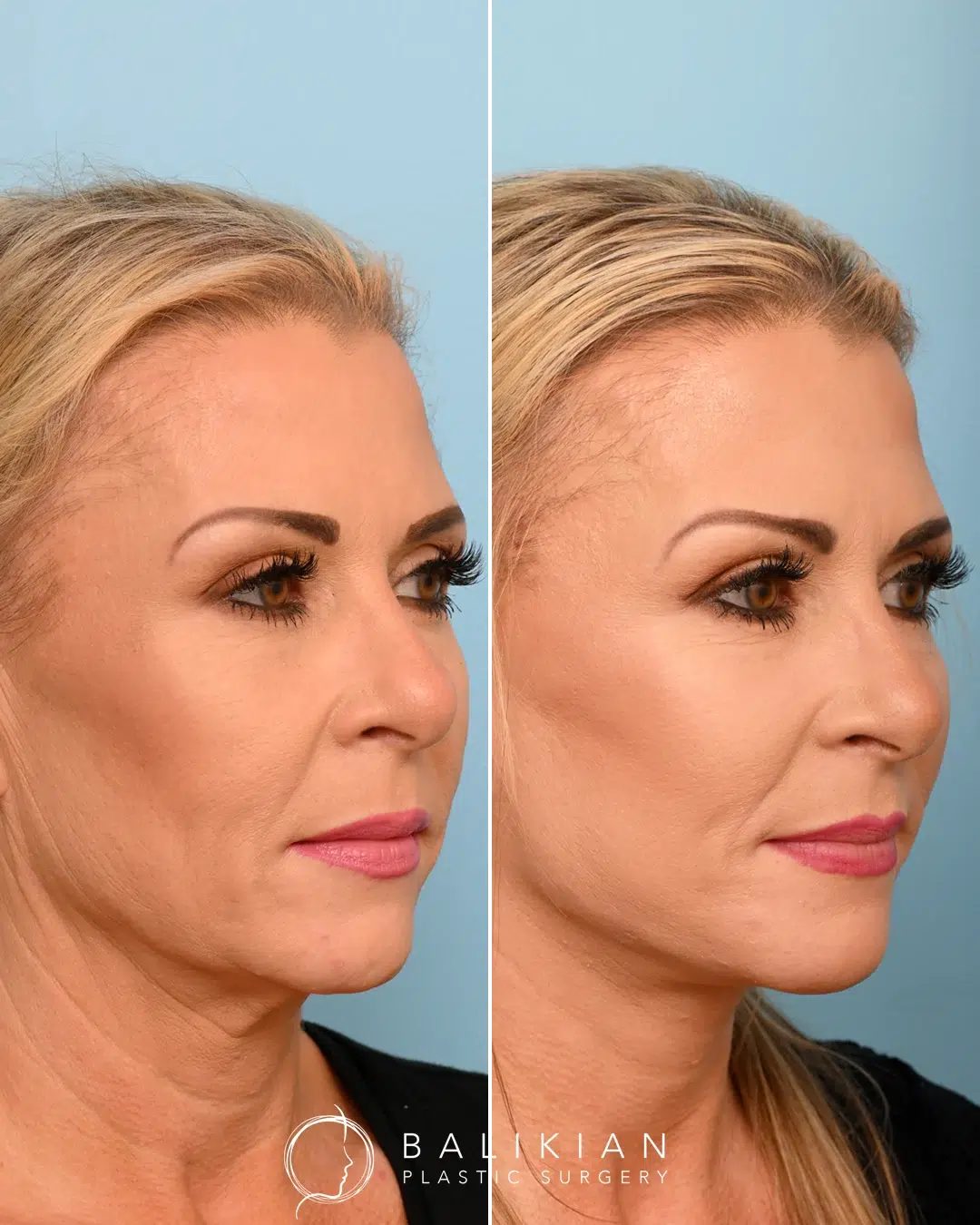 Angled view of a patient showing significant improvement in neck bands, jowls, and midface structure after facelift surgery