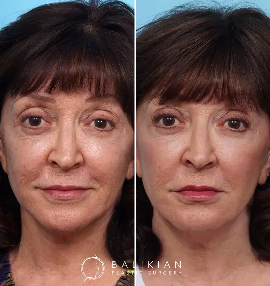 Before and after photos of a patient in her 70s after a Vampire Facial with microneedling, PRP, and Juvederm to the cheeks, chin, and upper lip, followed by a Perfect Peel for enhanced skin rejuvenation and wrinkle prevention