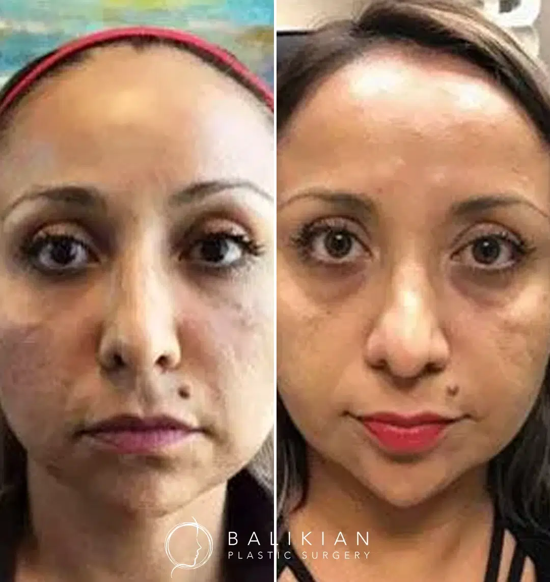 Before and after photos of a patient who received a Vampire Facial with microneedling, PRP injections under the eyes, and Juvederm filler in the jawline and chin to soften fine lines and enhance jawline definition