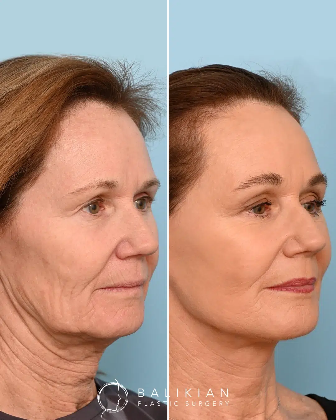 Before and after deep plane facelift showing tighter neck and jawline in older female patient