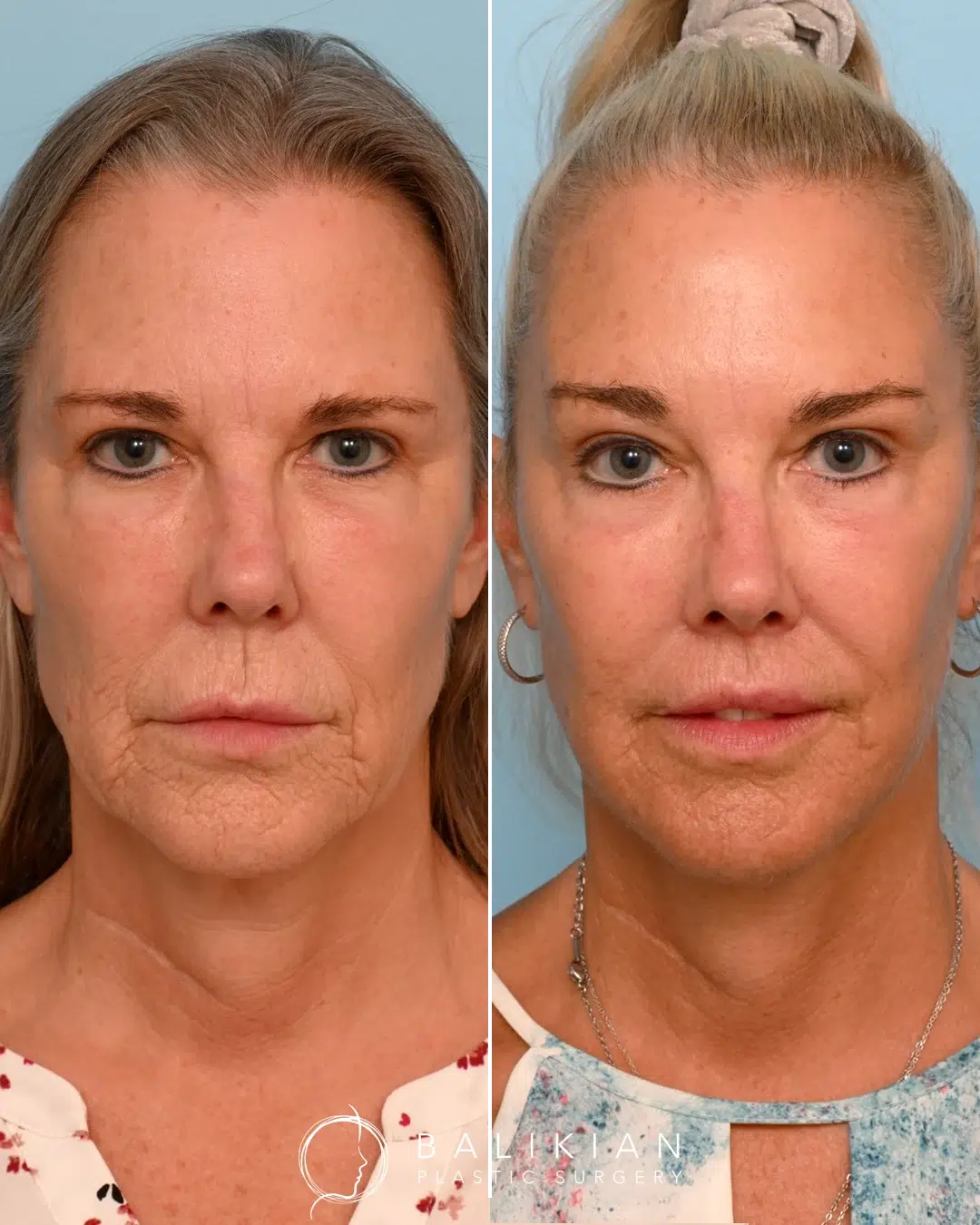 Frontal view of a woman before and after deep plane facelift, showing firmer skin, softened facial lines, and improved balance