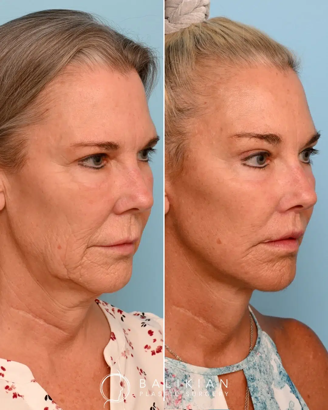 Angled before and after image of the same patient, emphasizing a lifted lower face, restored cheek volume, and defined jawline