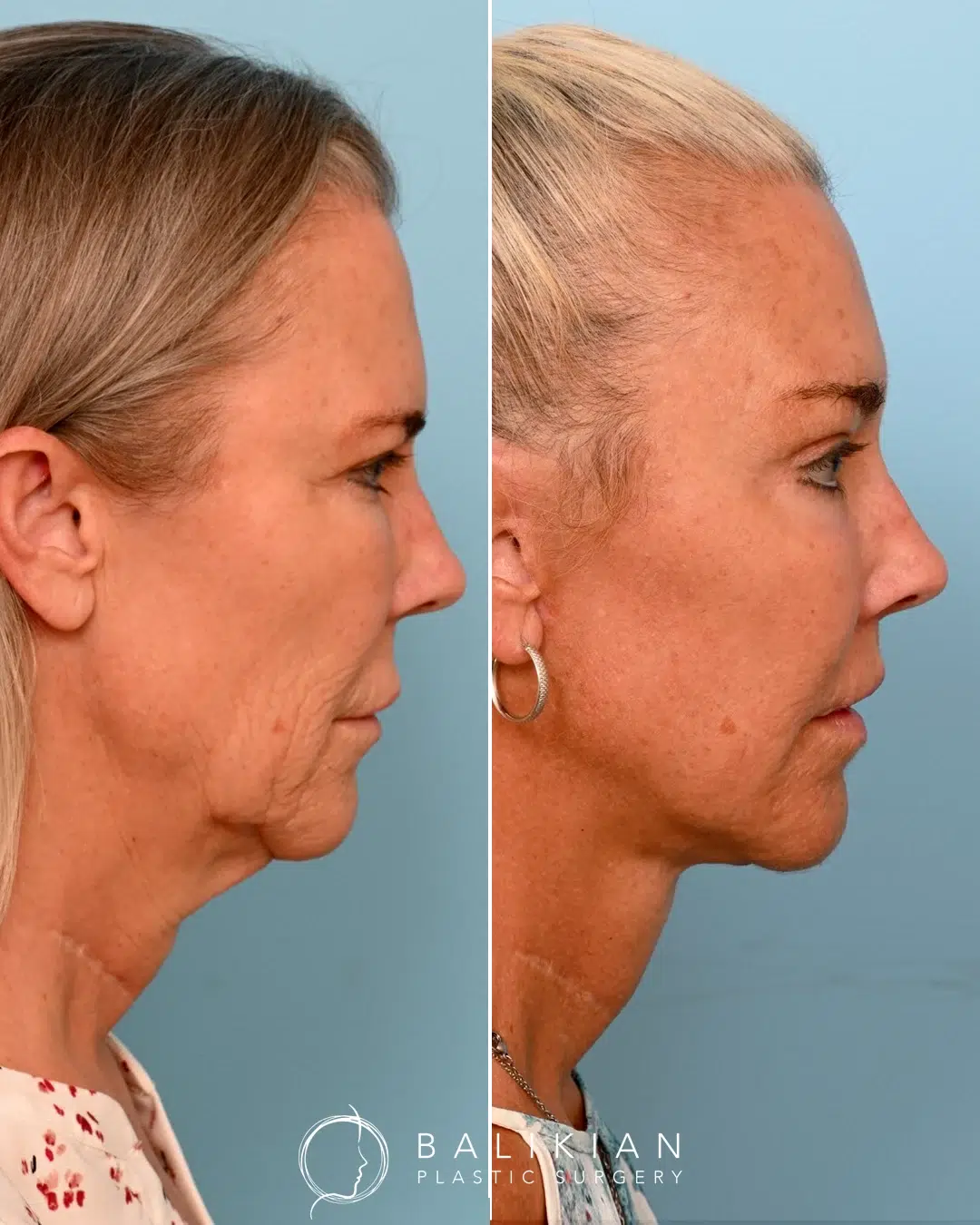 Side profile of a woman before and after facelift, revealing a refined neck angle, smoothed skin, and youthful facial contours
