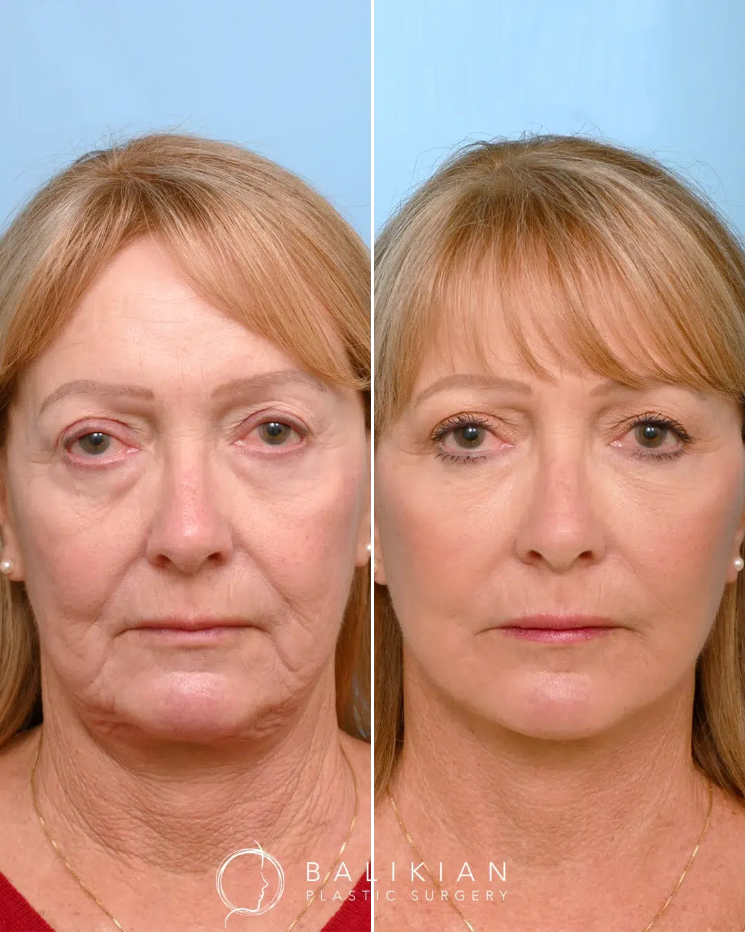Frontal facelift before and after of a woman with improved jawline and lifted midface