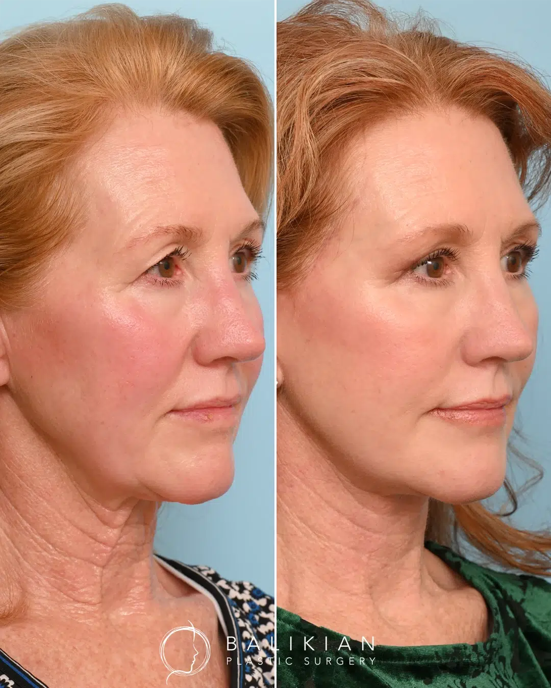 Side view before and after of a red-haired woman after facelift with smoother skin and lifted cheeks