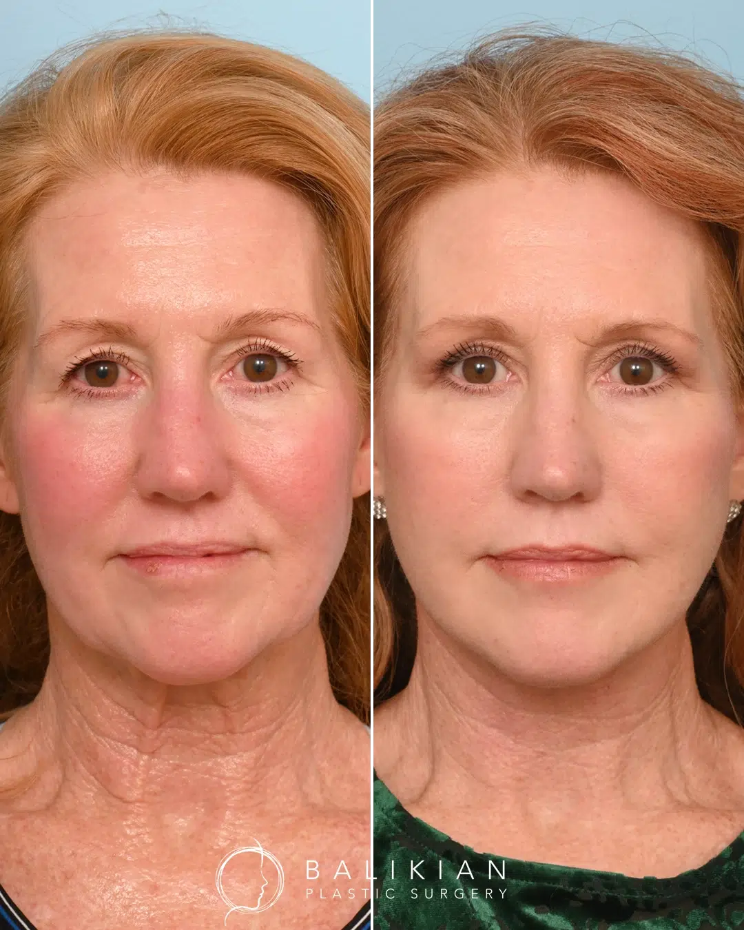 Frontal facelift result showing reduced sagging and refreshed facial appearance