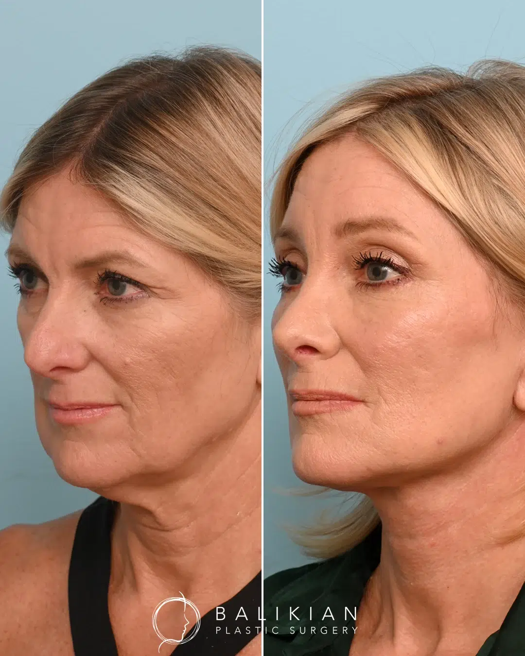 Before and after facelift image of a blonde woman showing improved neck and jaw contour