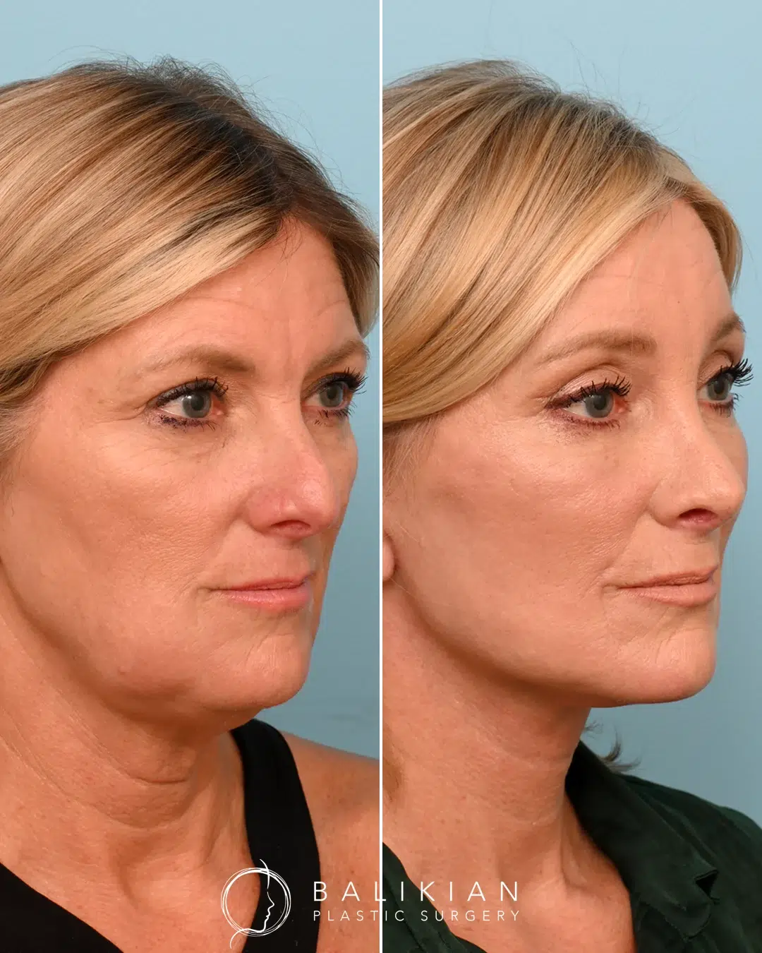 Oblique view facelift result showing firmer lower face and smoother skin texture
