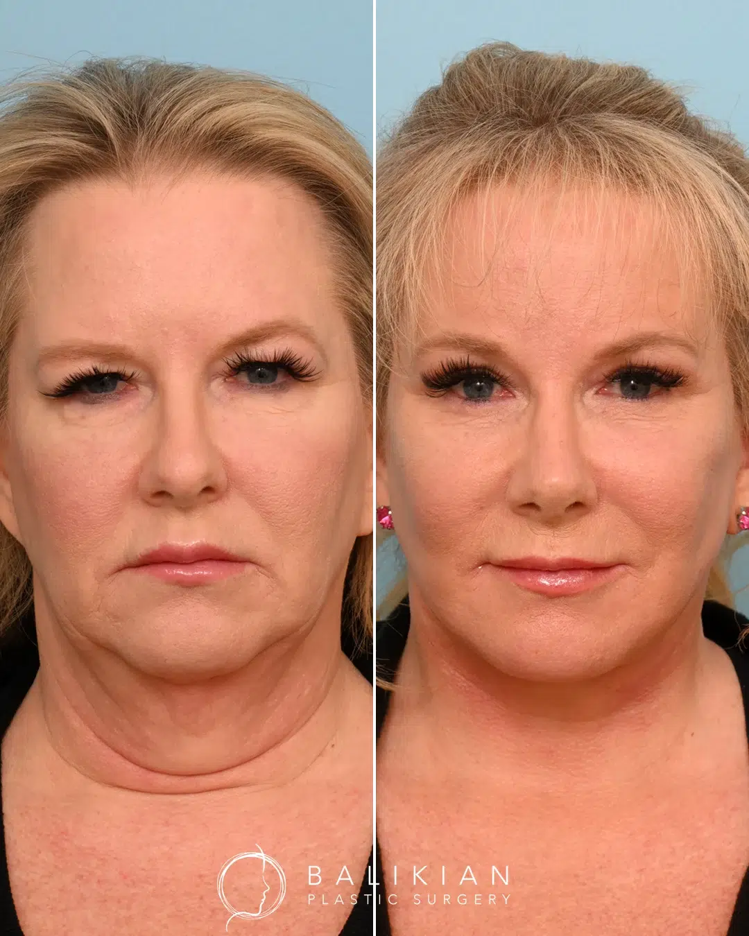 Frontal before and after of a woman post-facelift with a more defined jaw and lifted features