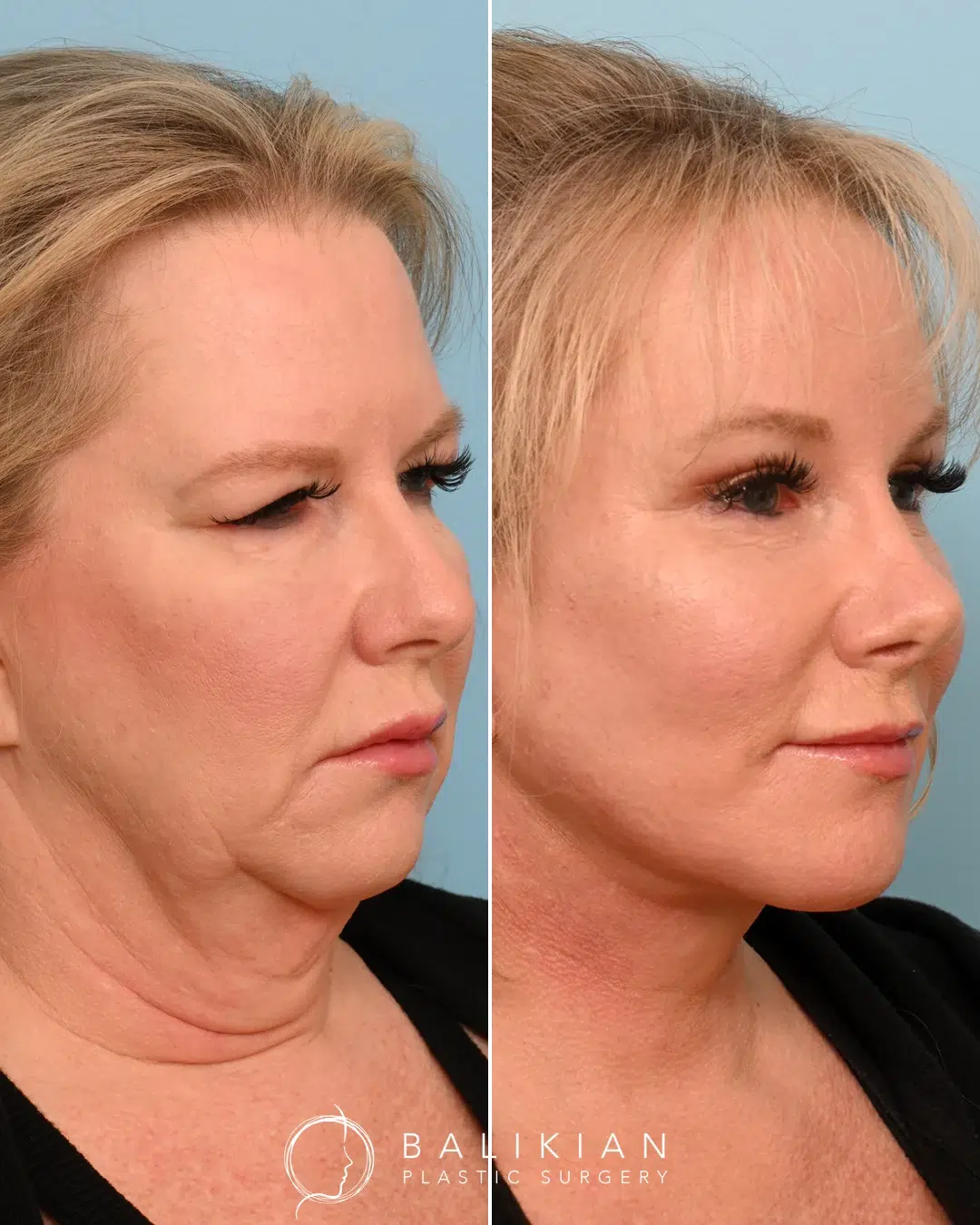 Side view of the same woman showing tightened neck and enhanced cheek contour post-facelift
