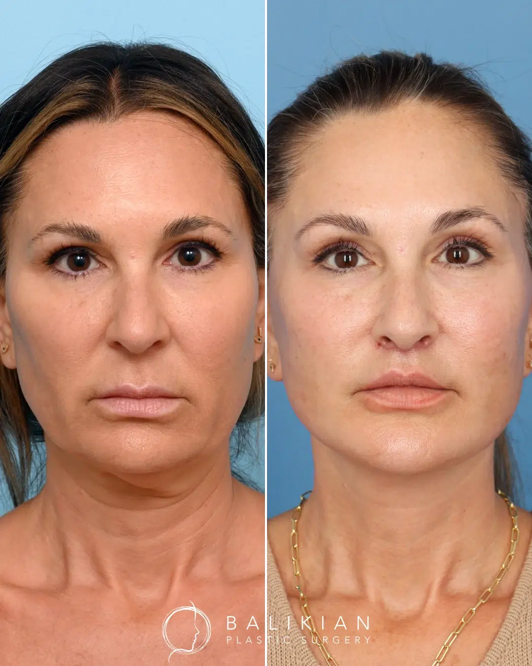 Front view of a female patient before and after facelift and neck lift, showing improved jawline definition, lifted cheeks, and smoother skin tone
