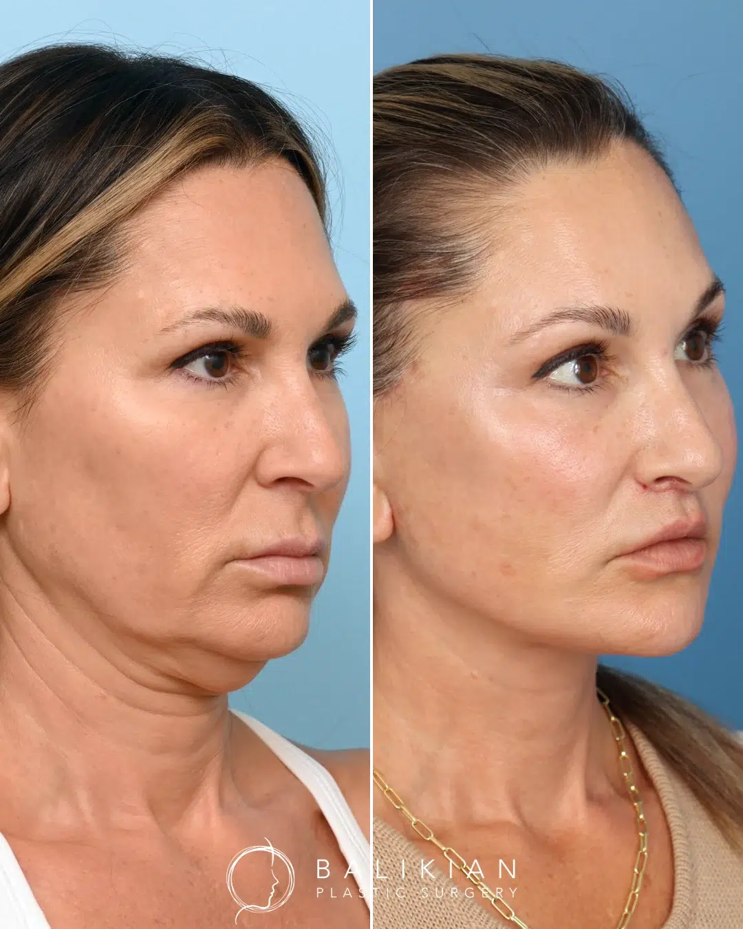 Left angled view of the same patient before and after deep plane facelift and neck lift, highlighting reduced neck fullness and restored facial contour