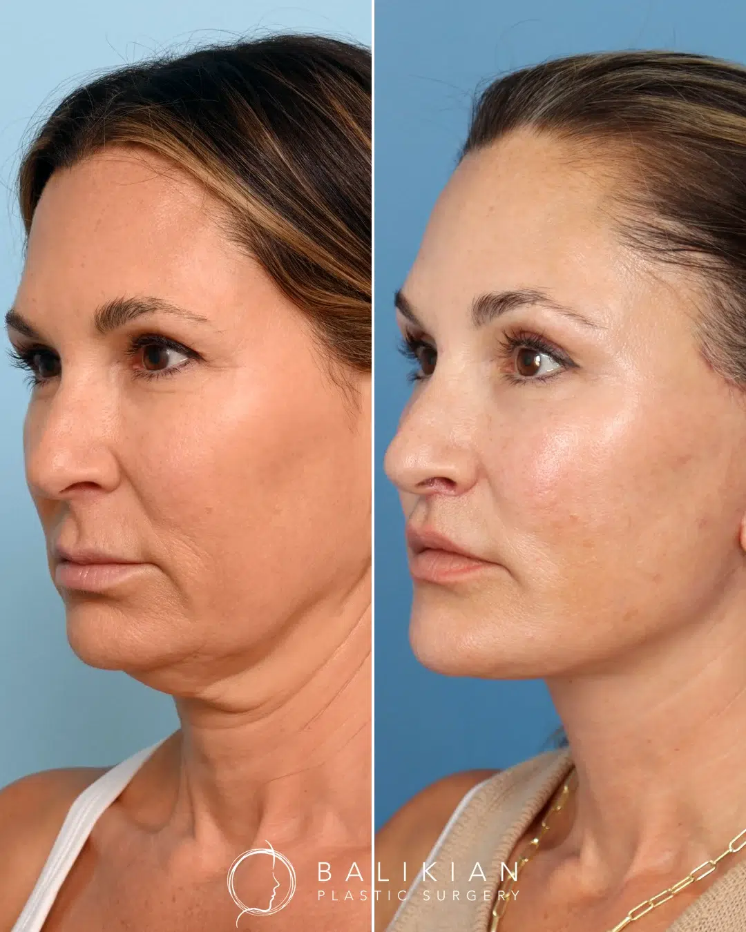 Right angled view before and after facelift, revealing enhanced jawline contour and smoother lower face and neck area