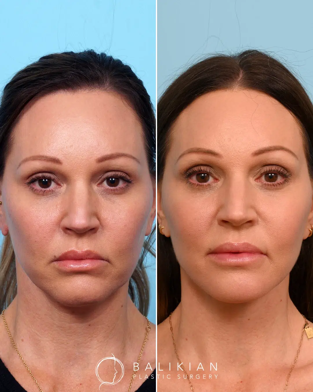 Front view of a second female patient before and after facelift, brow lift, and fat transfer, showing fuller midface volume and more youthful facial expression