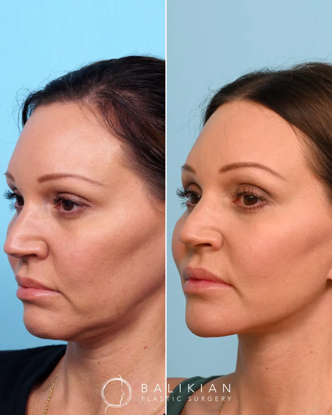 Left angled view before and after facial rejuvenation, illustrating lifted cheeks, defined jawline, and softened nasolabial folds