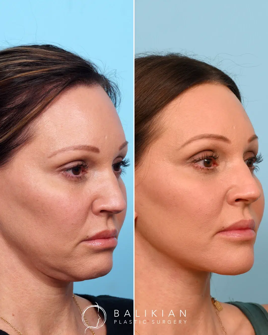 Right angled view of the same patient before and after surgery, emphasizing improved skin firmness and sculpted lower face and neck