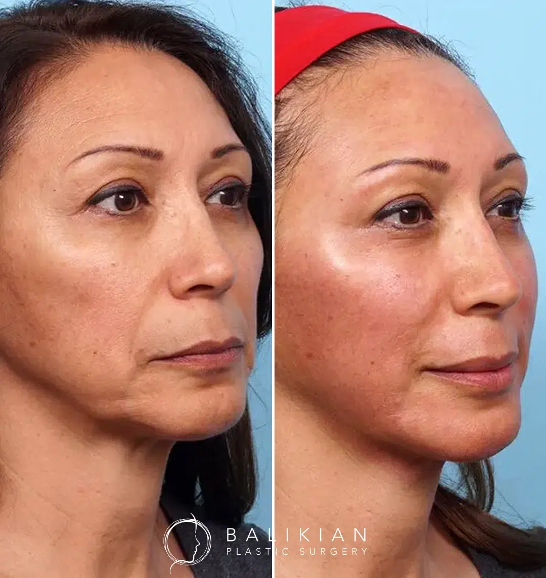 Immediate before and after photos of a non-surgical Vampire Facial with microneedling, PRP, and Juvederm to the chin and jawline for a more defined, rejuvenated appearance
