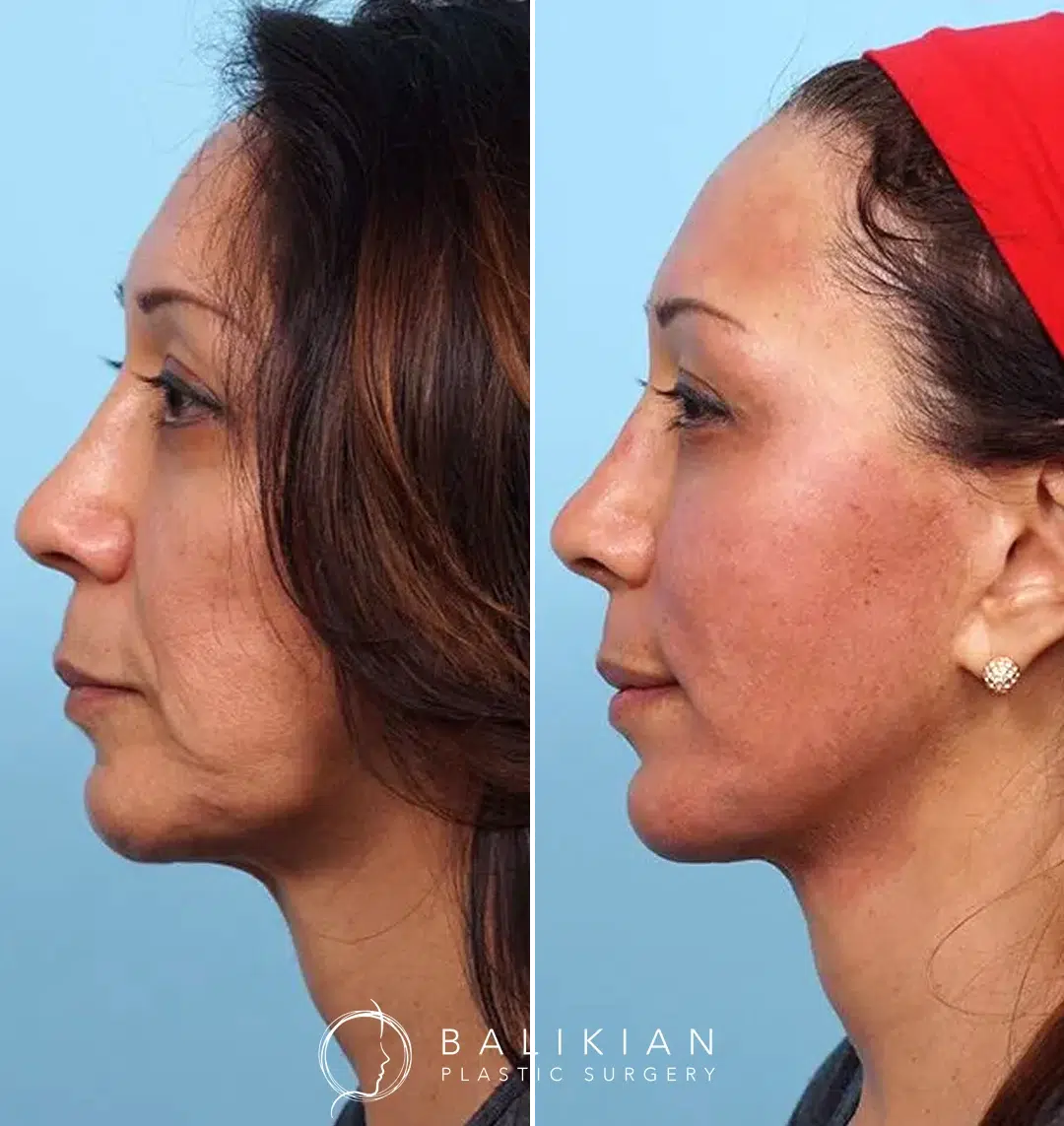 Immediate before and after photos of a non-surgical Vampire Facial with microneedling, PRP, and Juvederm to the chin and jawline for a more defined, rejuvenated appearance