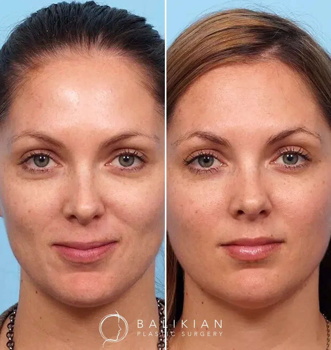 Before and after images of a patient who underwent a Vampire Facial and a Perfect Peel.