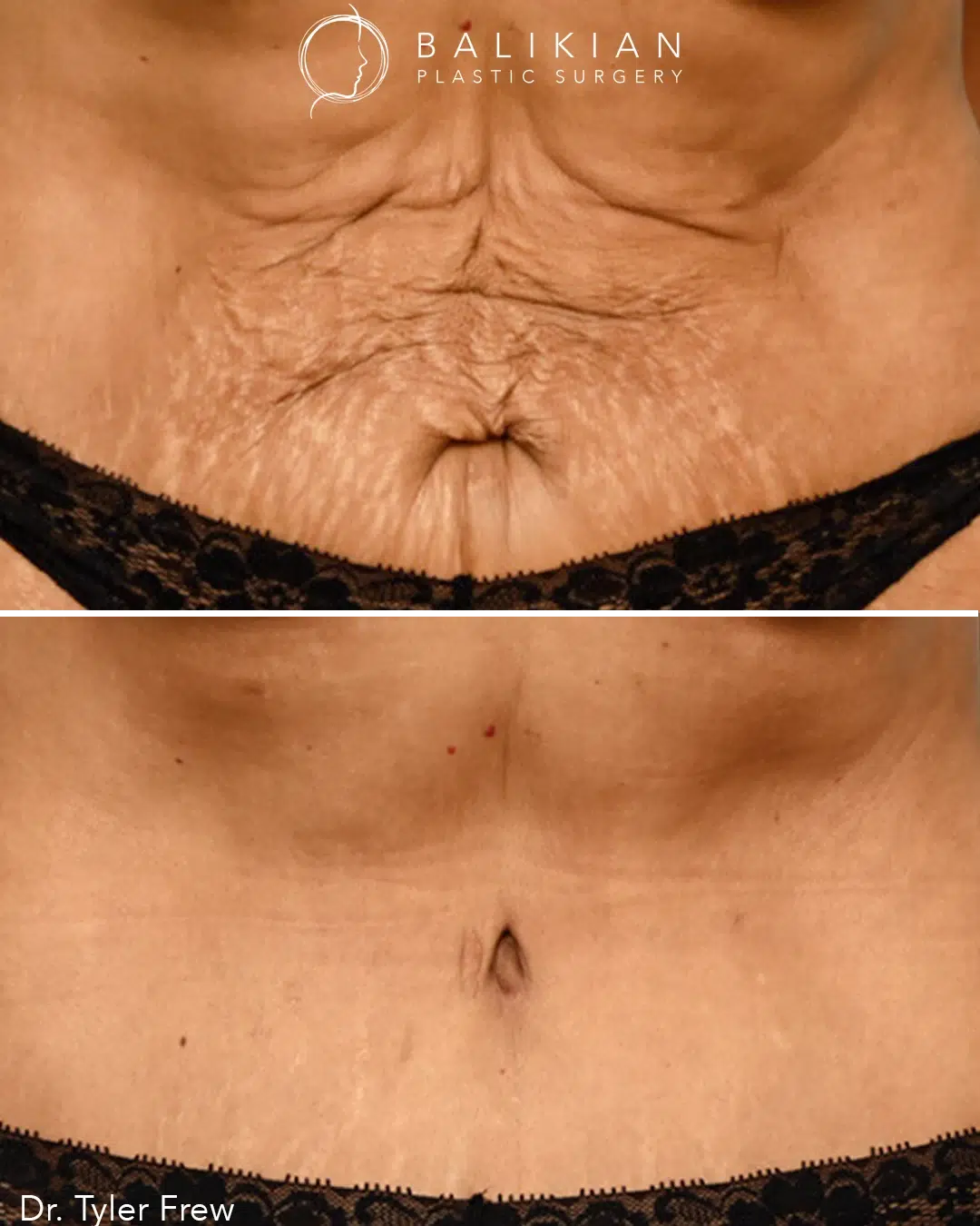 Before: significant wrinkling and sagging skin around the navel. After: smooth, tightened skin with a more youthful appearance.