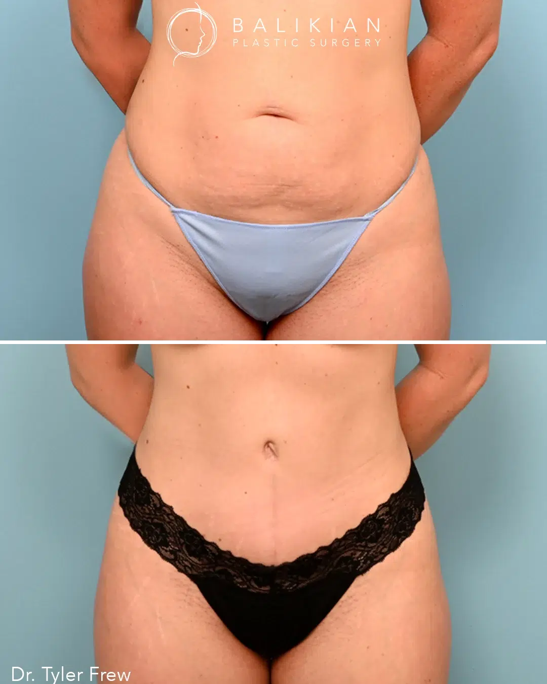 Before: loose skin and abdominal fullness. After: toned, firm abdomen with slimmer waistline.
