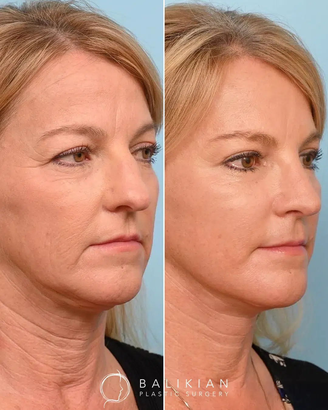Facelift before and after left oblique view of a middle aged woman showing smoother skin, lifted cheeks, and a defined jawline and neck.