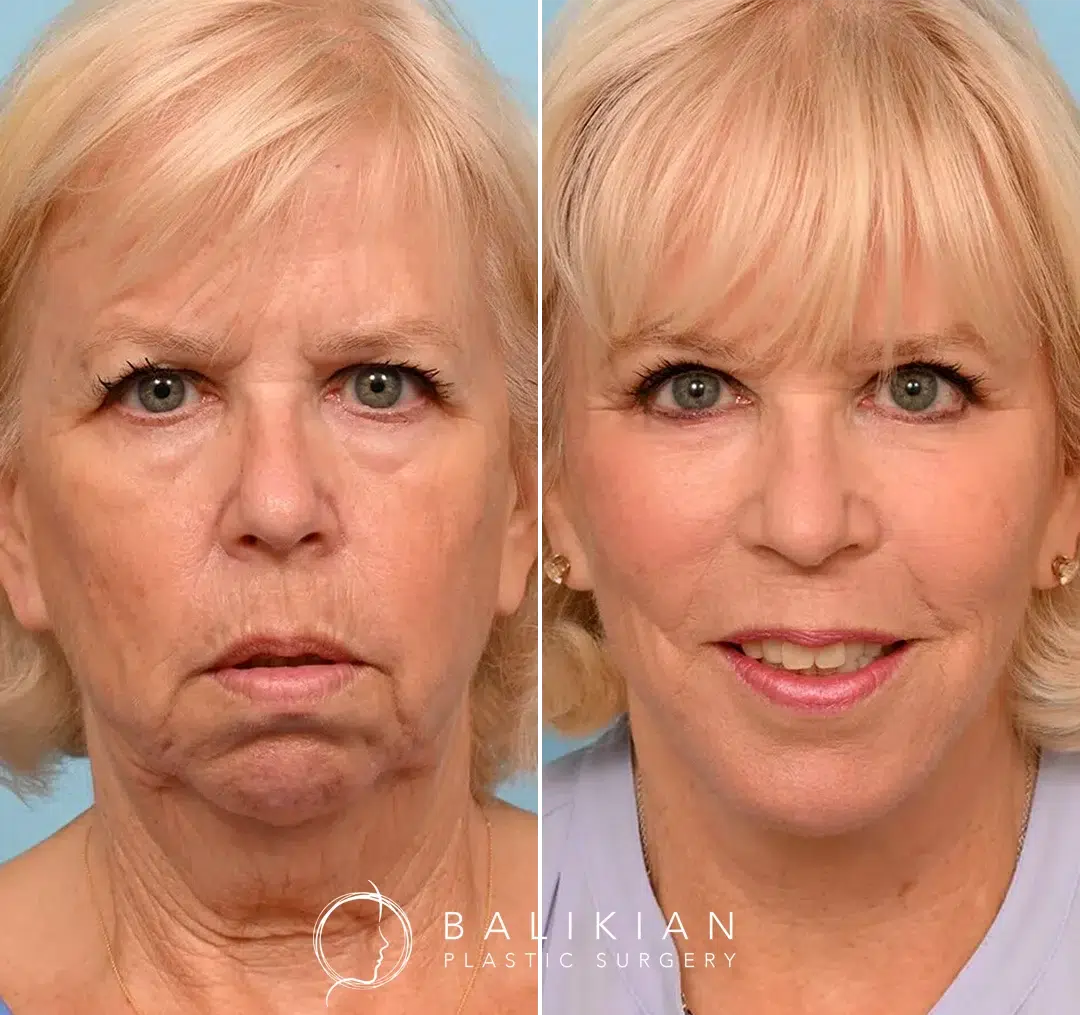 Before-and-after photos of an older woman following a deep plane facelift at Balikian Plastic Surgery, showing smoother skin, lifted cheeks, and a more youthful, refreshed appearance.