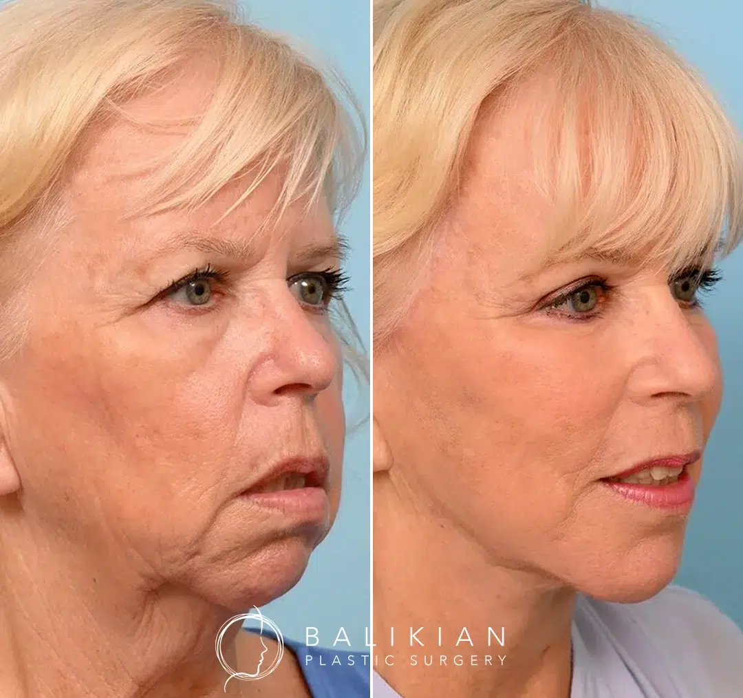 Side view before-and-after photos of a woman after facelift surgery, with improved jawline definition, tightened neck, and lifted facial contours.