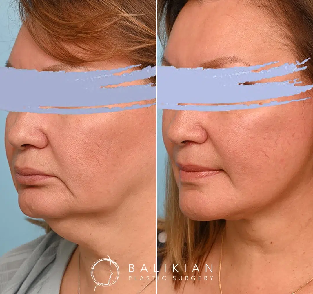 Angled view before and after facelift and neck lift, showing natural lift and smooth neckline.