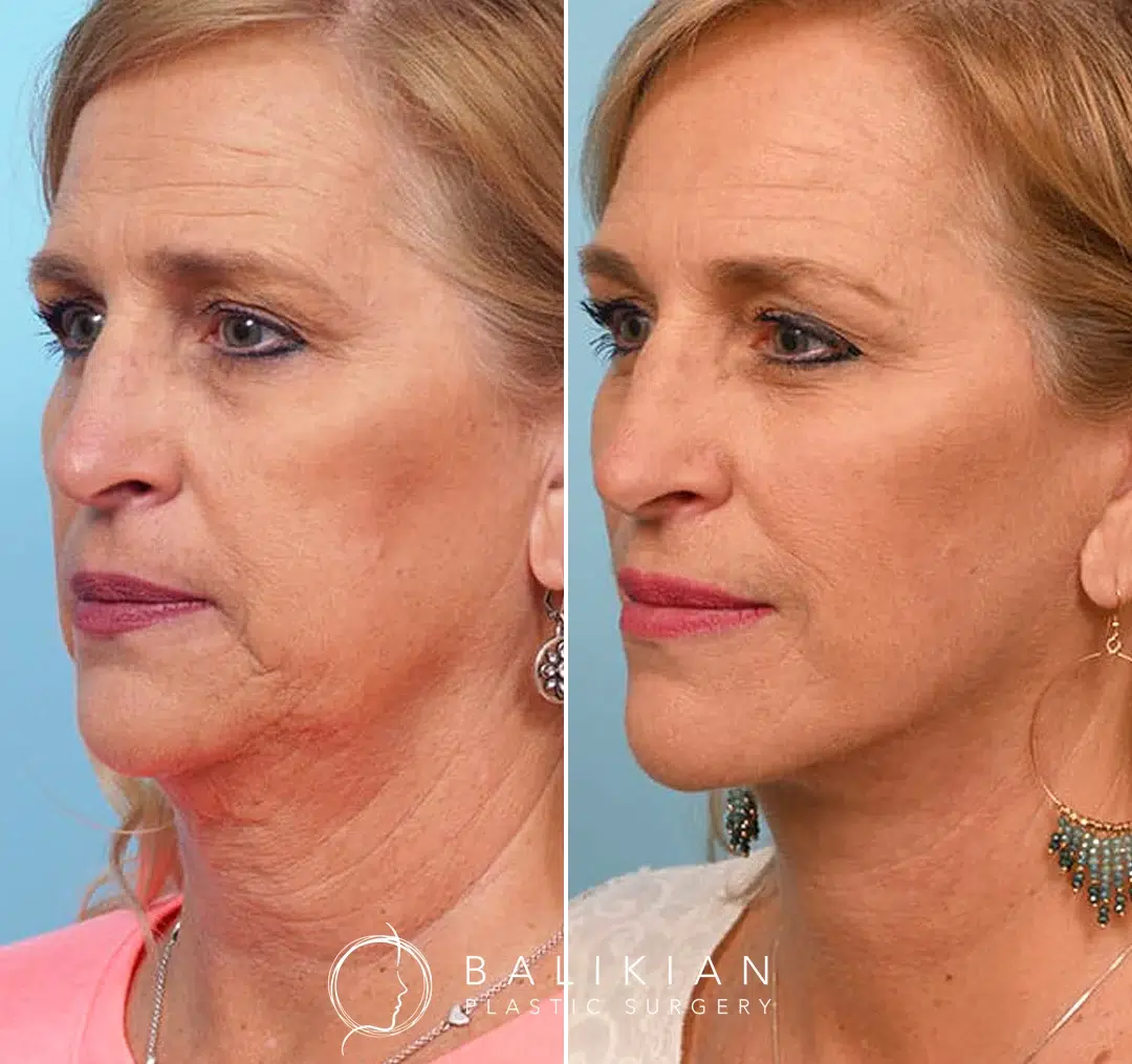 Woman before and after facelift and neck lift, showing tighter jawline and smoother neck.