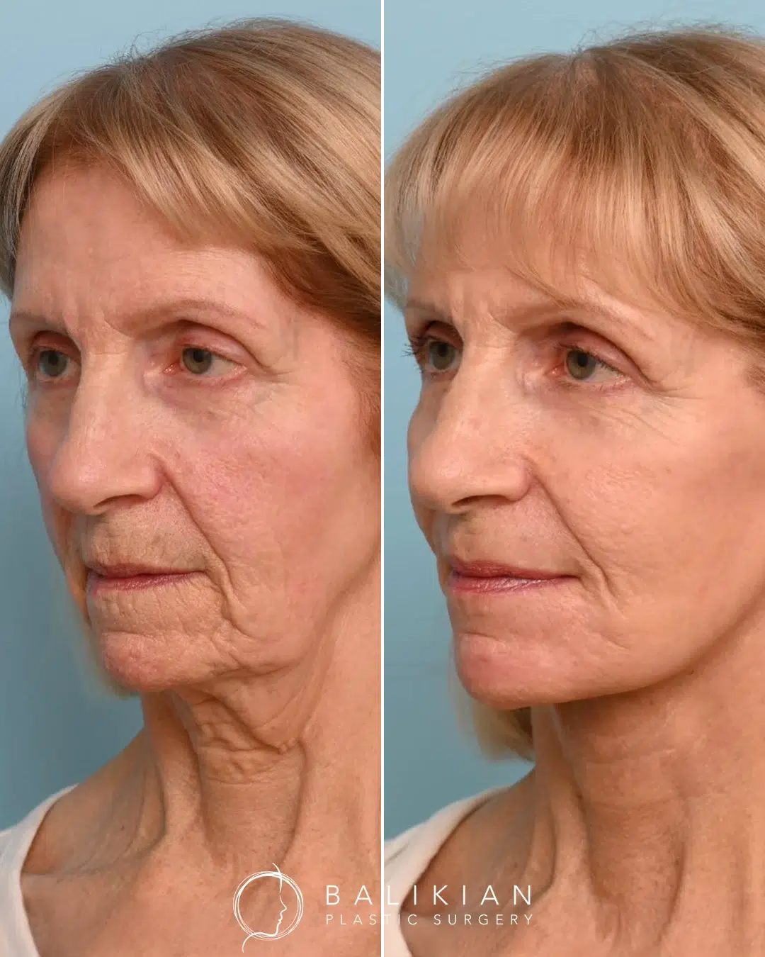 Facelift before and after right oblique view of an older woman with reduced jowls, smoother neck contour, and lifted midface.