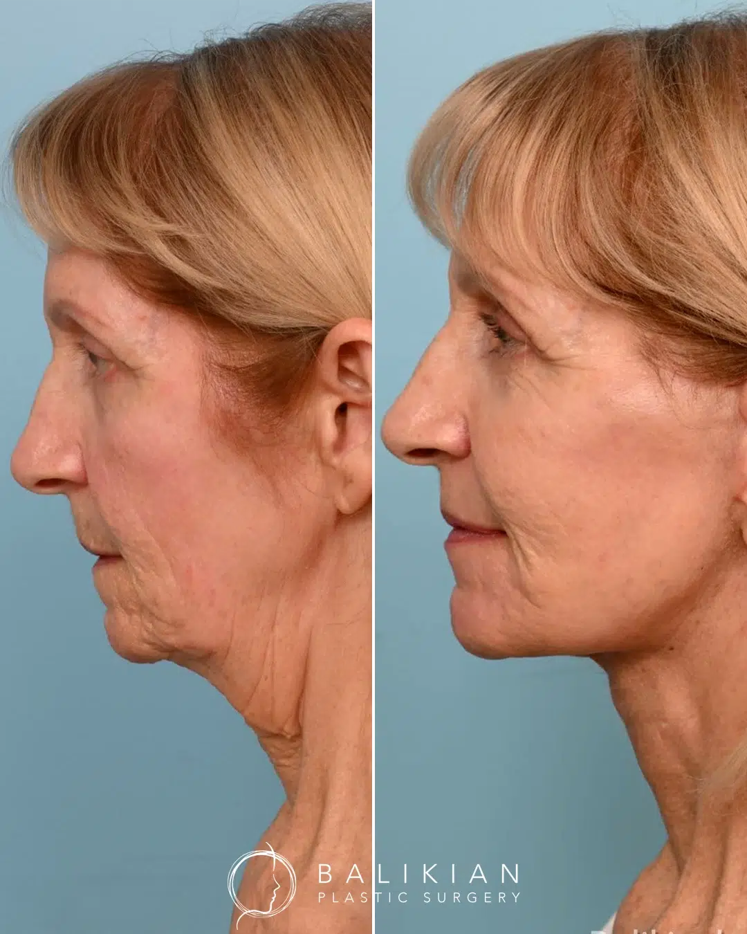 Facelift and neck lift before and after profile view showing tightened skin under the chin, a firm jawline, and natural rejuvenation.