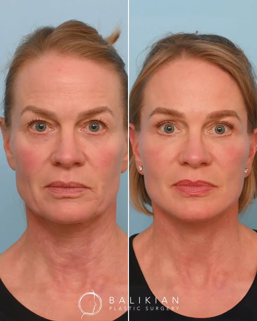 Front view before and after Artiste Lift facelift and neck lift in Temecula Valley showing smoother jawline and neck.