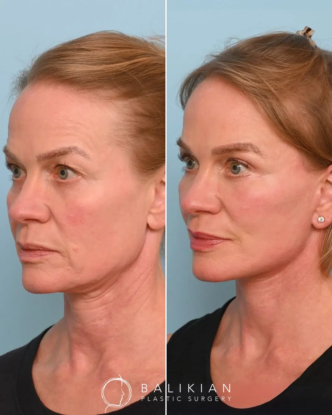 Three-quarter view before and after Artiste Lift facelift and neck lift with improved facial contours and neckline.