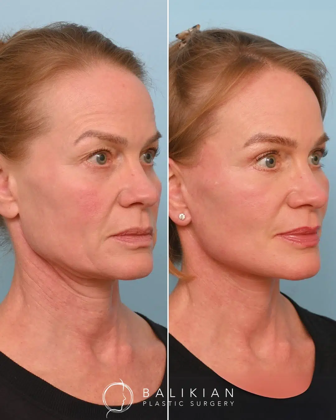 Three-quarter opposite view before and after facelift and neck lift showing lifted cheeks and defined jawline.