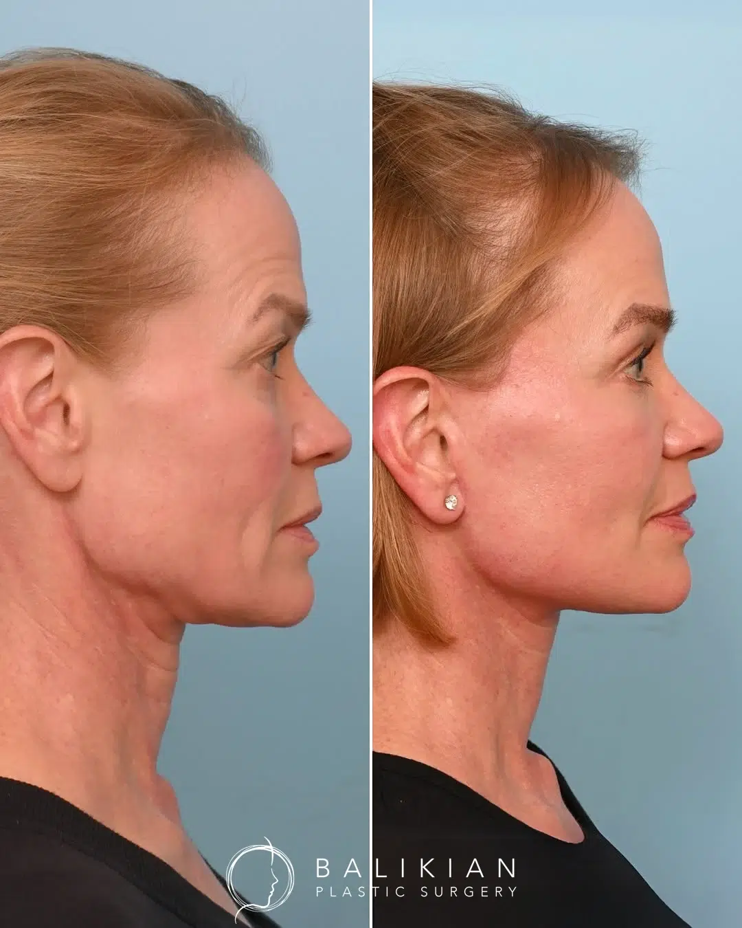 Profile view before and after Artiste Lift facelift and neck lift highlighting a sharper chin and smoother neckline.