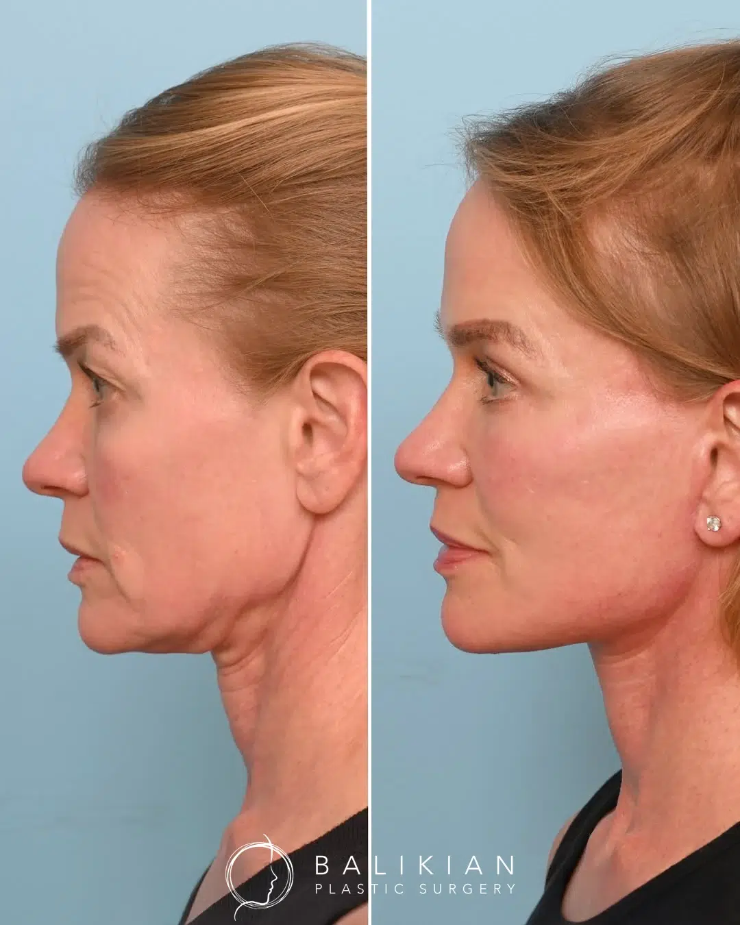 Opposite profile before and after facelift and neck lift with refined jawline and youthful neck contour.